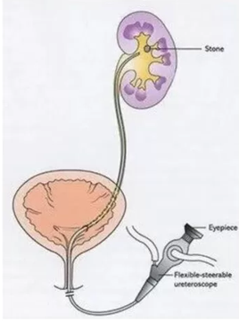 Flexible Ureteroscopy (RIRS)