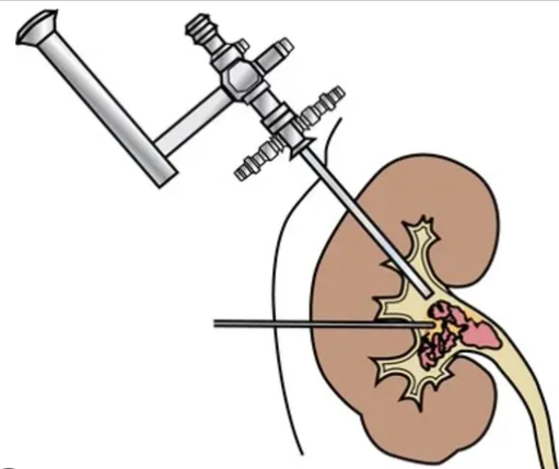 PCNL