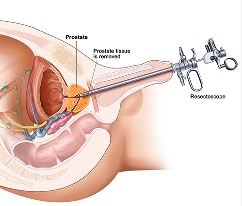 Bipolar TURP System