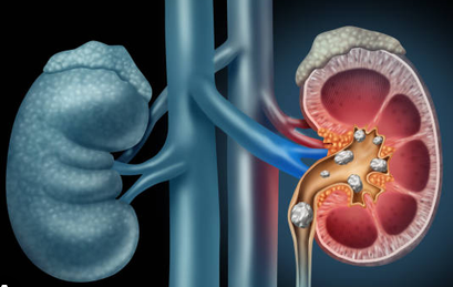 Kidney Stone Treatment
