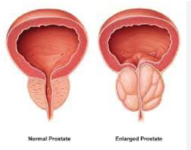 Enlarged Prostate (BPH)
