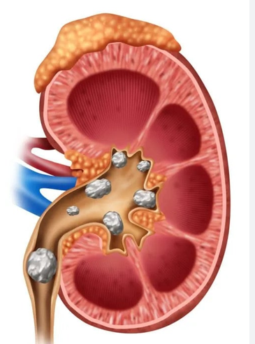 Kidney Stone Treatment